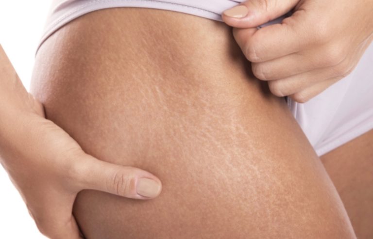 How To Deal With Stretch Marks & Scars